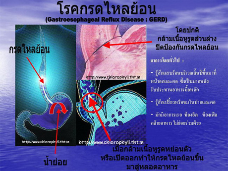 โรคกรดไหลย้อน โรคใกล้ตัวที่ไม่ควรมองข้าม
