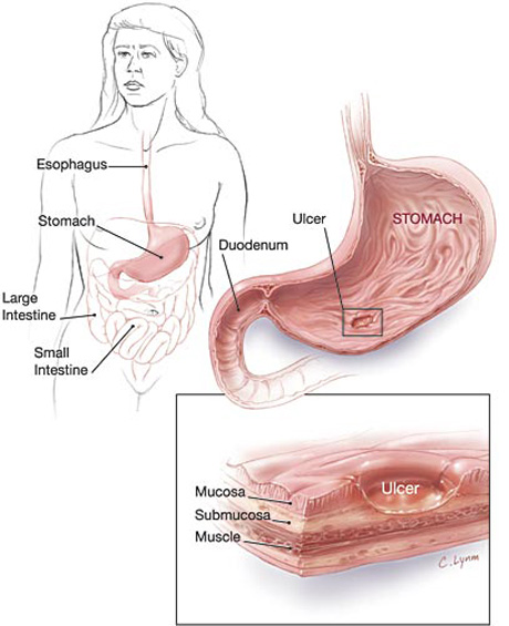 โรคกระเพาะอาหาร รู้ไว้ดีกว่า