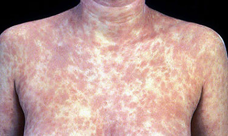 โรคซิฟิลิส ป้องกันได้ง่ายกว่าที่คิด