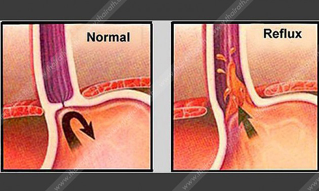 โรคกรดไหลย้อน โรคใกล้ตัวที่ไม่ควรมองข้าม