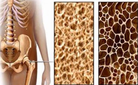 โรคกระดูกพรุน สามารถป้องกันได้