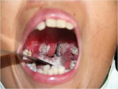 โรคคอตีบ สามารถป้องกันได้