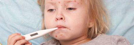 โรคหัด โรคติดต่อที่ควรรู้